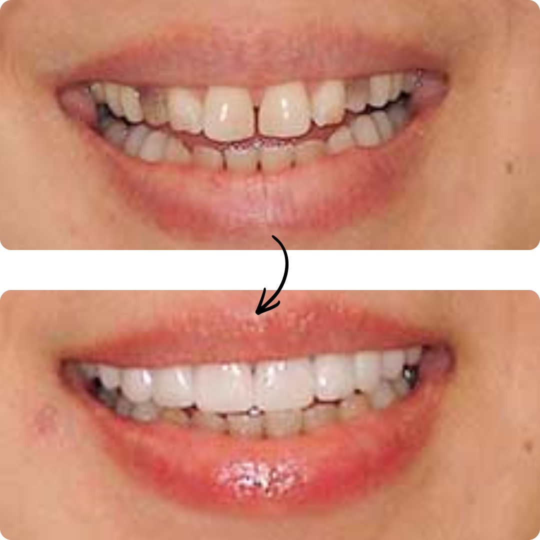 Before and after veneers result 1