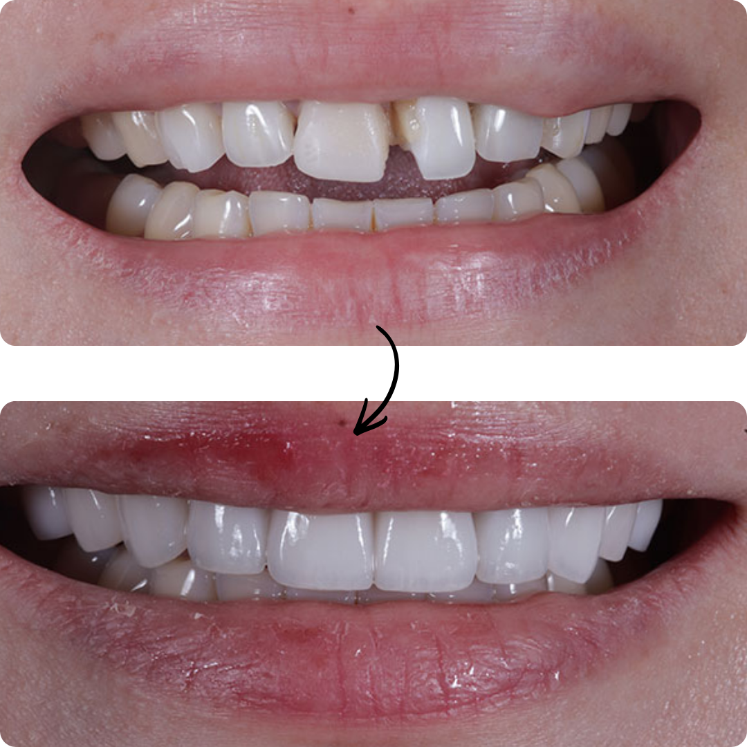 Before and after veneers result 4