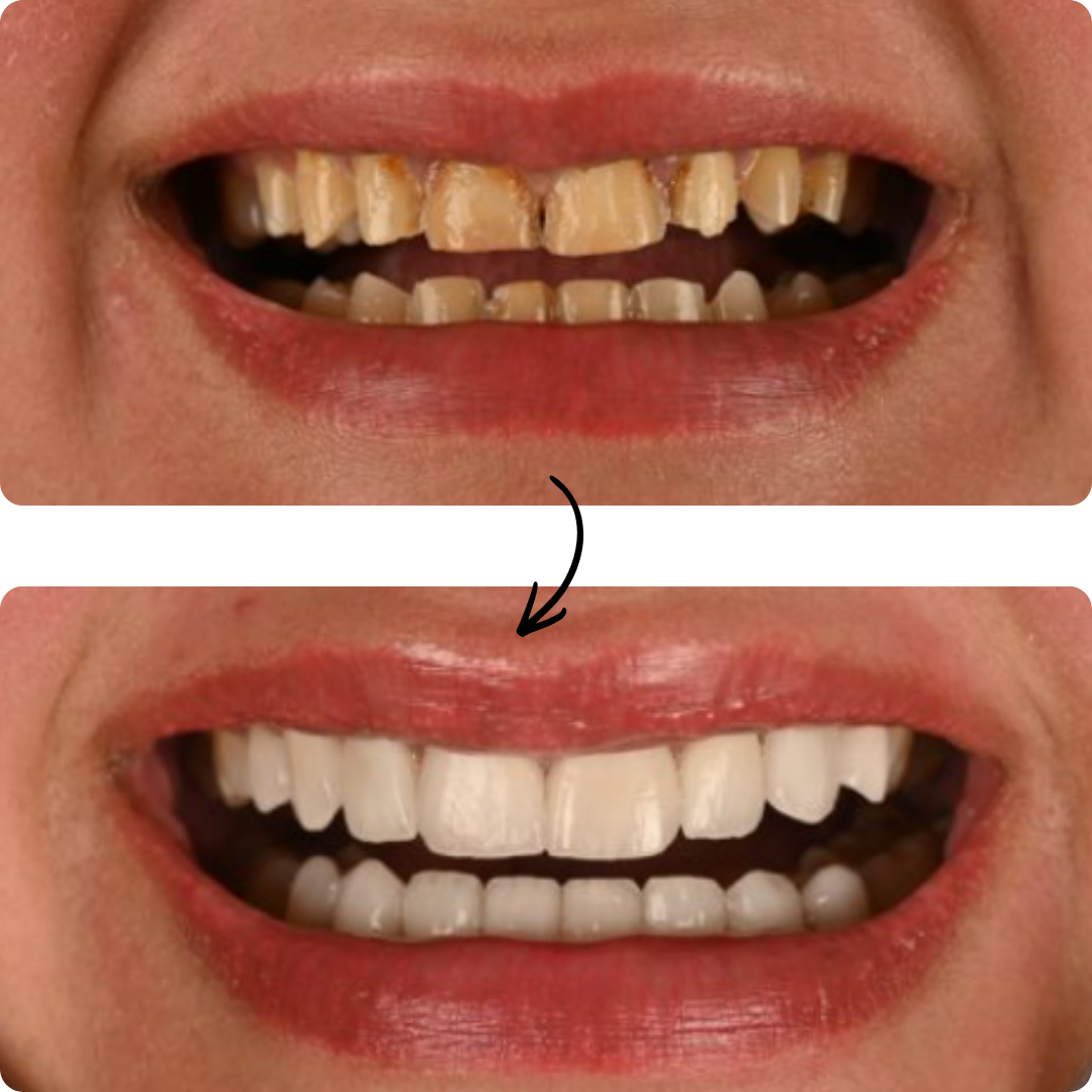 Before and after veneers result 2