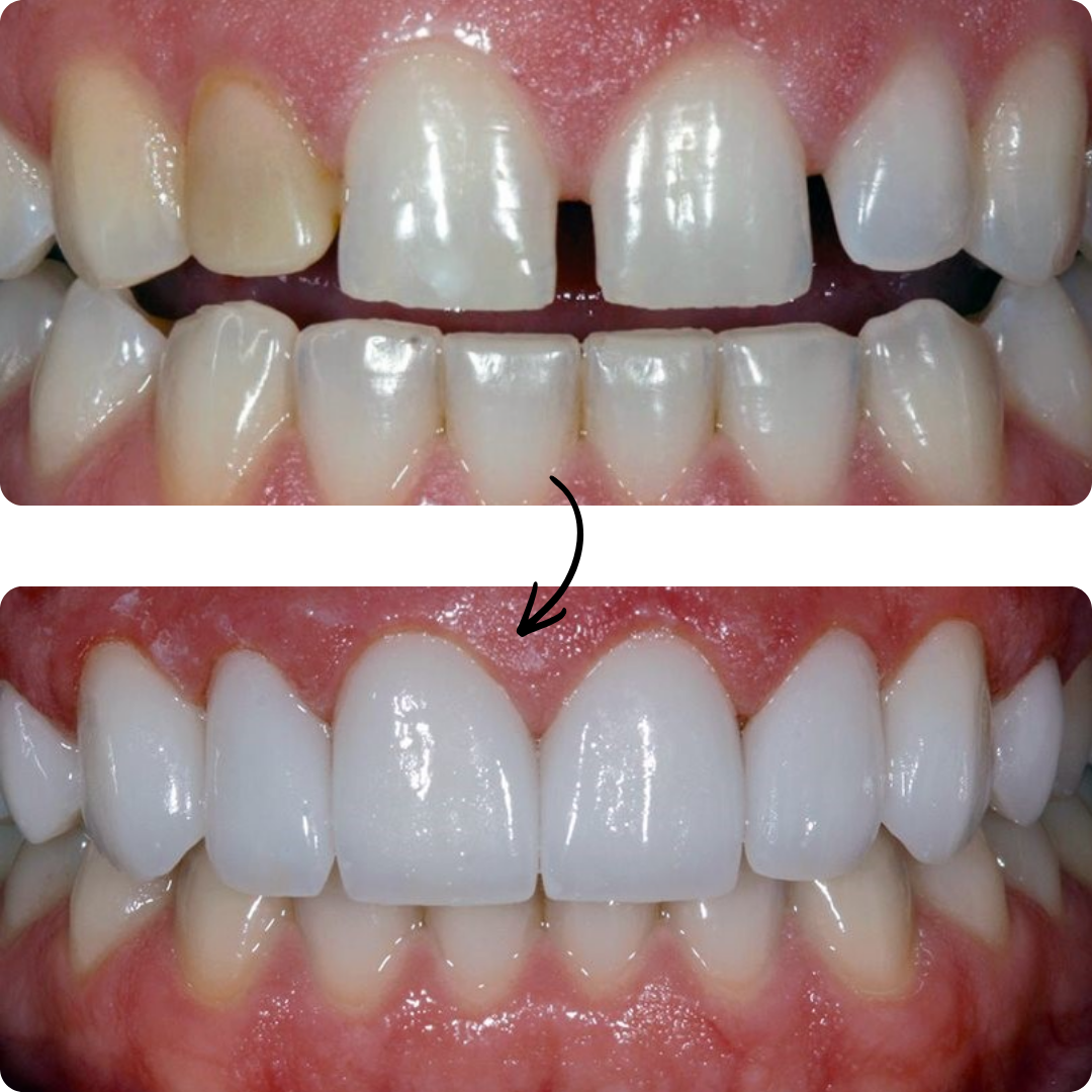 Before and after veneers result 5