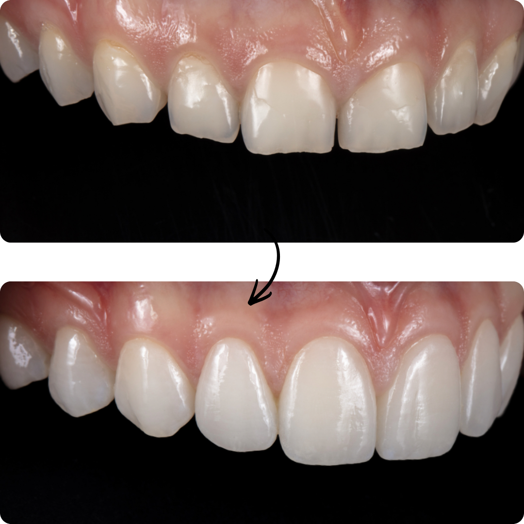 Before and after veneers result 3